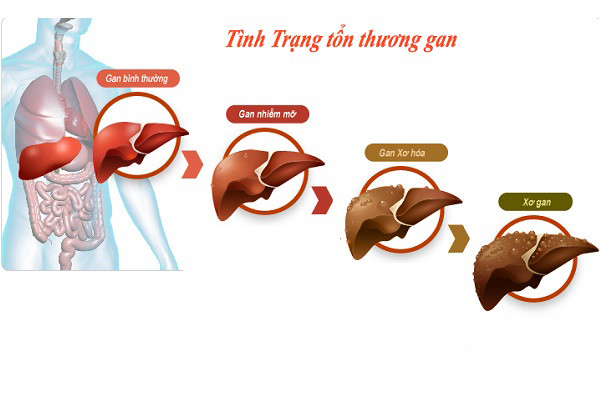 benh xo gan co chua duoc khong 1