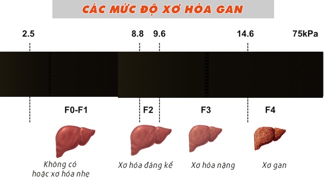benh xo gan co chua duoc khong 2