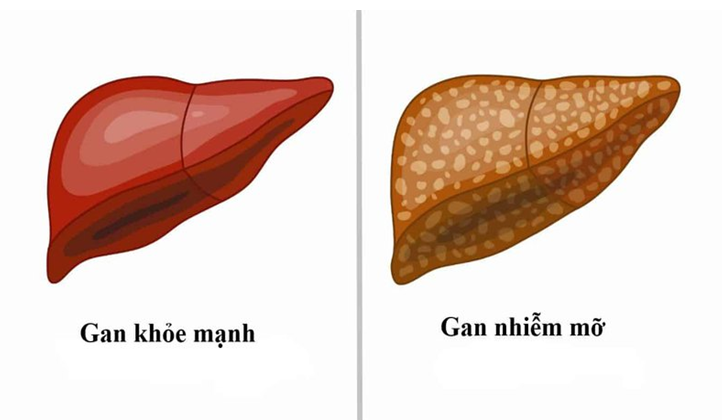 gan nhiem mo 2