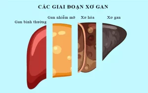 c&aacute;c giai đoạn xơ gan