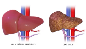 gan bị xơ h&oacute;a