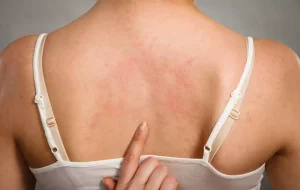 Dấu hiệu mới bị xơ gan Dấu hiệu mới bị xơ gan